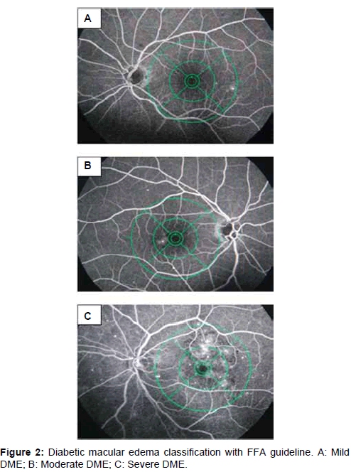 Diabetic Macular Edema Classification 3022