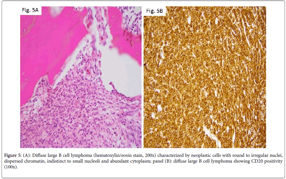 diagnostic-pathology-hematoxylin-neoplastic