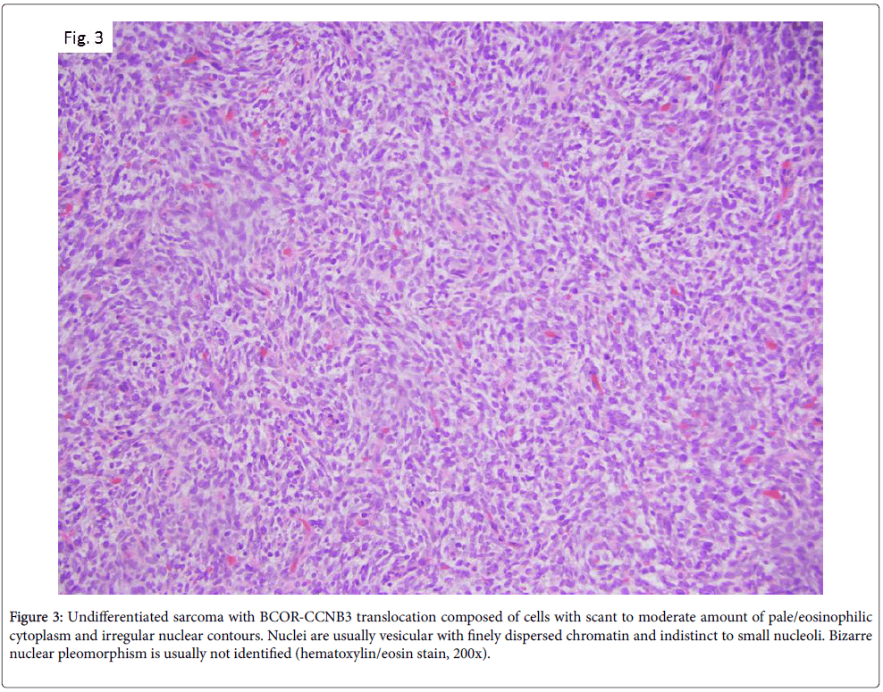 diagnostic-pathology-sarcoma-nuclear