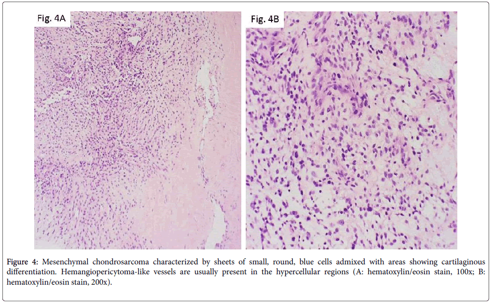 diagnostic-pathology-sarcoma-nuclear