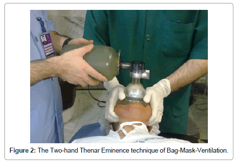 mask ventilation thenar bag difficult eminence two technique figure hand overcome recents approaches