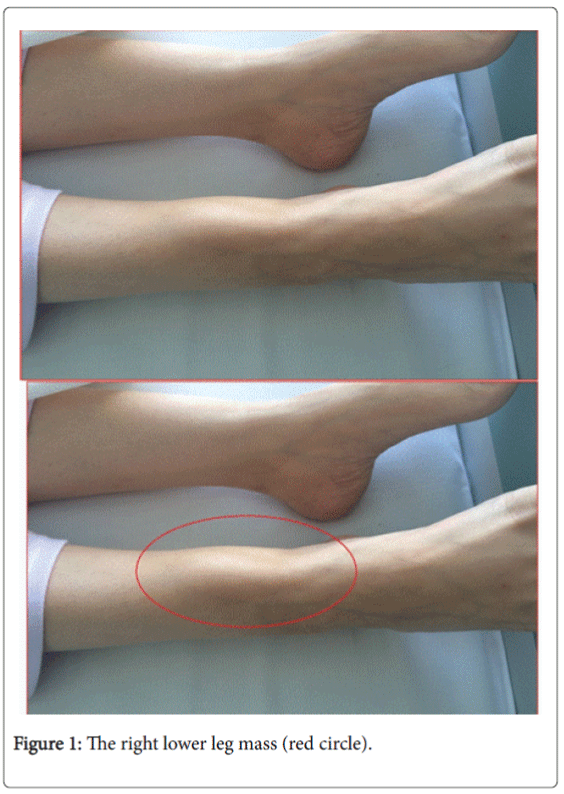 endocrinology-metabolic-syndrome-right-lower-leg