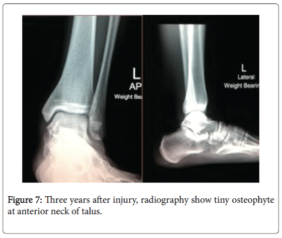 Case Report: Closed Posteromedial Dislocation of the Ankle without