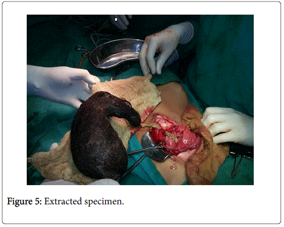 gastrointestinal-digestive-Extracted-specimen