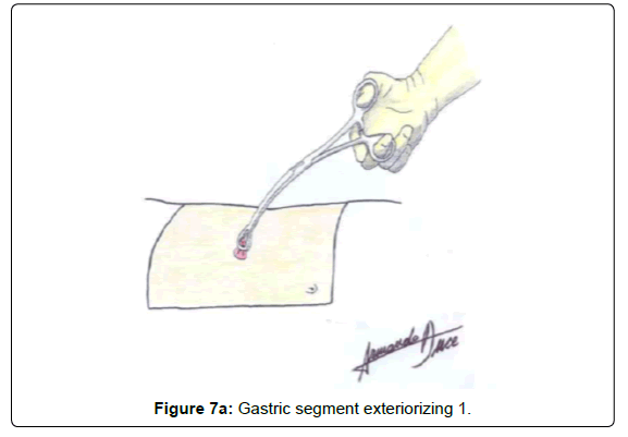 gastrointestinal-digestive-Gastric-segment-exteriorizing