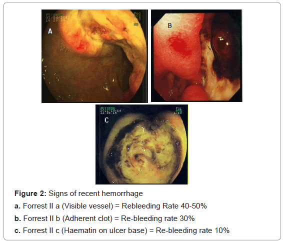 gastrointestinal-digestive-Haematin-ulcer-base