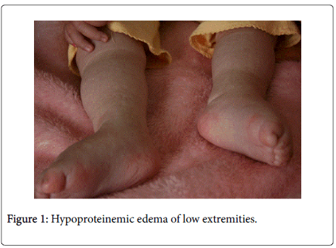 gastrointestinal-digestive-Hypoproteinemic-edema