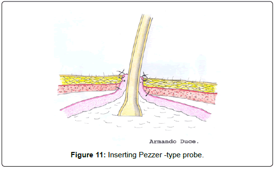 gastrointestinal-digestive-Inserting-Pezzer