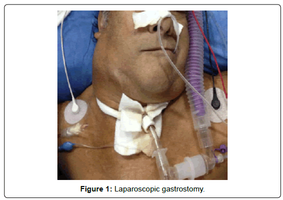 The application of single-port laparoscopic percutaneous internal