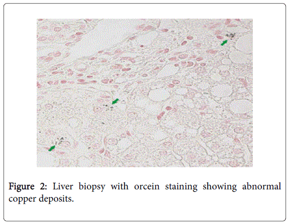 gastrointestinal-digestive-Liver-biopsy-orcein