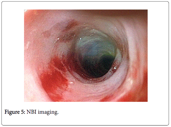 gastrointestinal-digestive-NBI-imaging