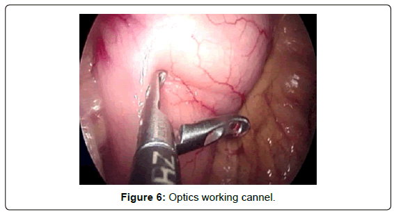 gastrointestinal-digestive-Optics-working-cannel