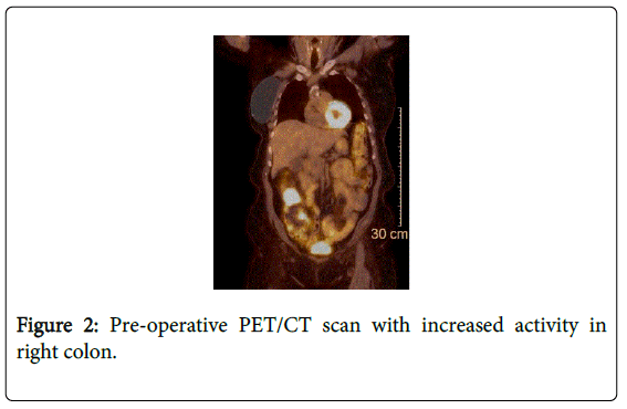 gastrointestinal-digestive-Pre-operative-PET-CT