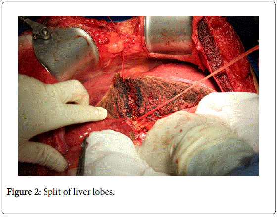 gastrointestinal-digestive-Split-liver-lobes