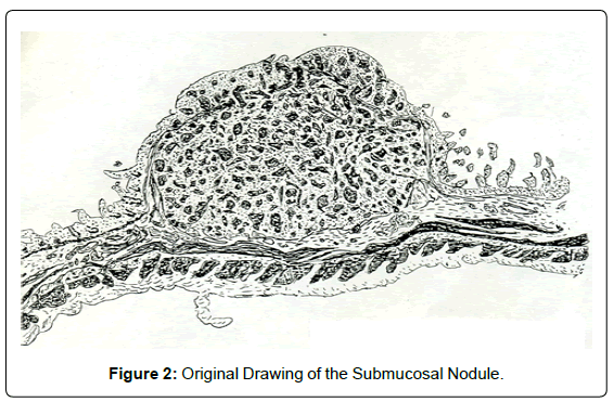 gastrointestinal-digestive-Submucosal-Nodule