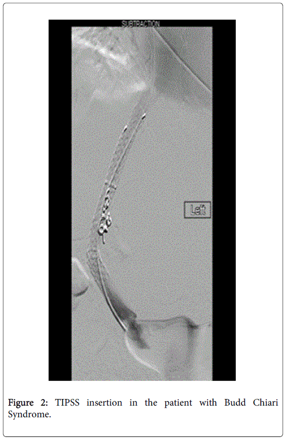 gastrointestinal-digestive-TIPSS-insertion-patient