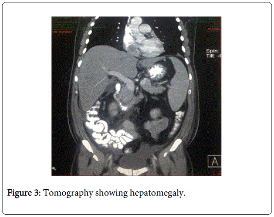 gastrointestinal-digestive-Tomography-hepatomegaly