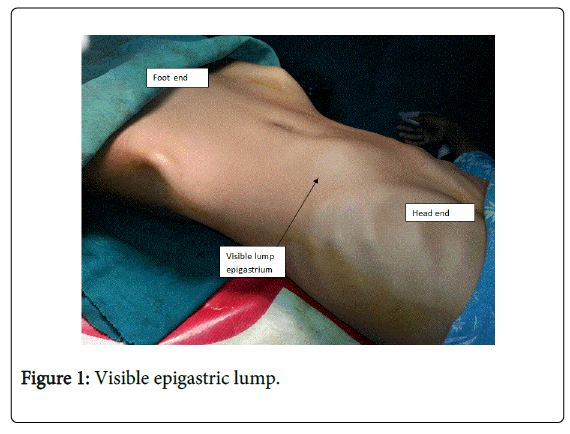 gastrointestinal-digestive-Visible-epigastric-lump