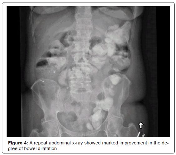 gastrointestinal-digestive-degree-bowel-dilatation