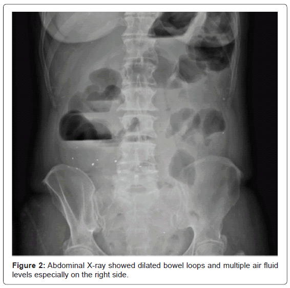 gastrointestinal-digestive-dilated-bowel-loops