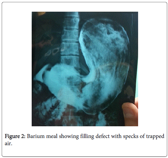 gastrointestinal-digestive-filling-defect-specks