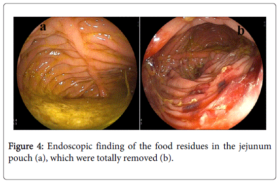 gastrointestinal-digestive-food-residues-jejunum