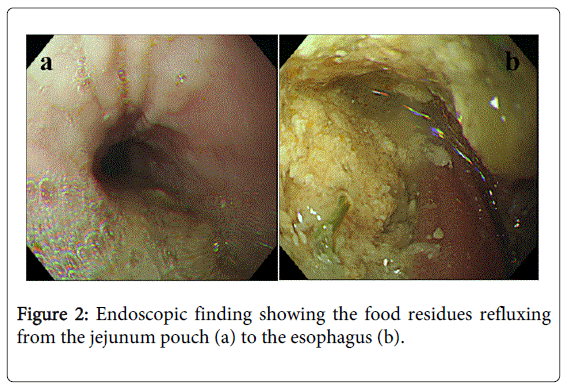 gastrointestinal-digestive-food-residues-refluxing