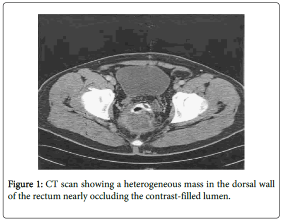 gastrointestinal-digestive-heterogeneous-dorsal-wall