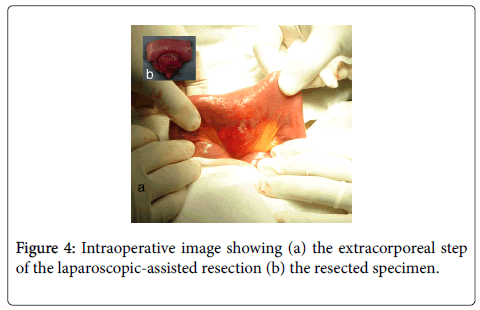 gastrointestinal-digestive-laparoscopic-assisted-resection