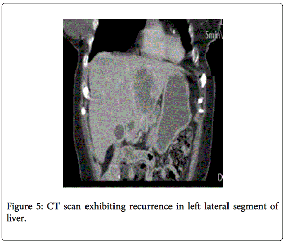 gastrointestinal-digestive-left-lateral-segment