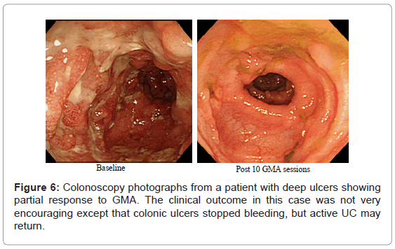 gastrointestinal-digestive-partial-response-GMA