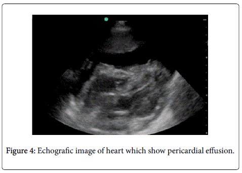 gastrointestinal-digestive-pericardial-effusion