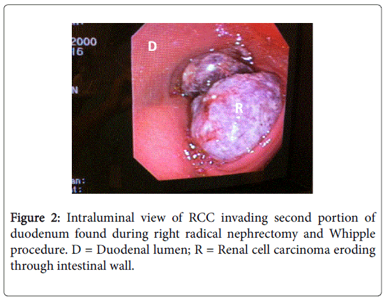 gastrointestinal-digestive-radical-nephrectomy