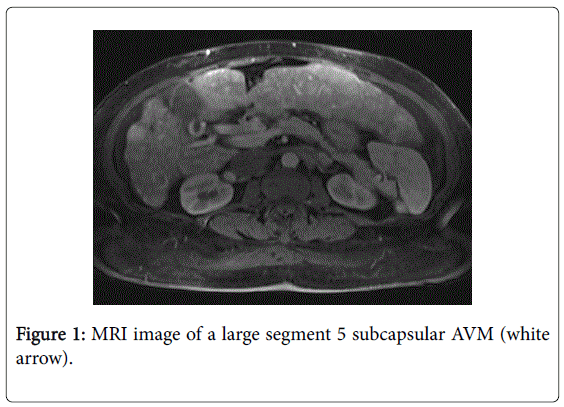 gastrointestinal-digestive-subcapsular-AVM