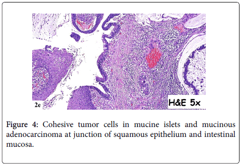 gastrointestinal-digestive-system-Cohesive-tumor