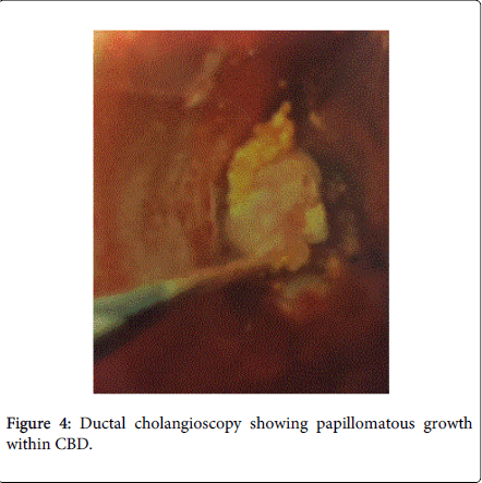 gastrointestinal-digestive-system-Ductal-cholangioscopy