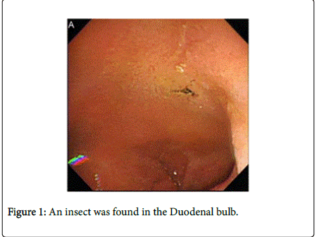 gastrointestinal-digestive-system-Duodenal-bulb