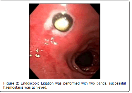 gastrointestinal-digestive-system-Endoscopic-Ligation