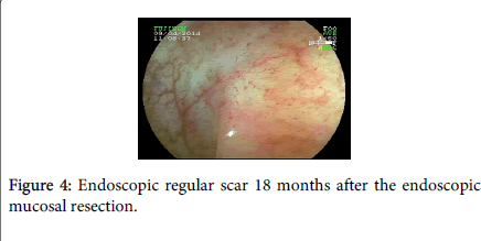 gastrointestinal-digestive-system-Endoscopic-regular