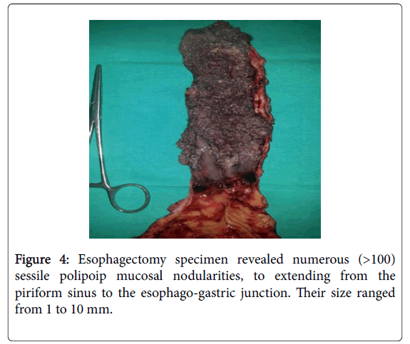 gastrointestinal-digestive-system-Esophagectomy-specimen