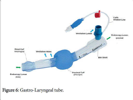 gastrointestinal-digestive-system-Gastro-Laryngeal