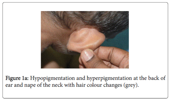 gastrointestinal-digestive-system-Hypopigmentation-hyperpigmentation