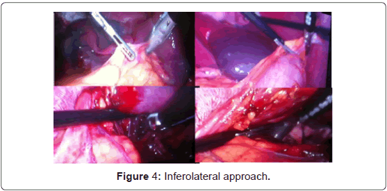 gastrointestinal-digestive-system-Inferolateral-approach