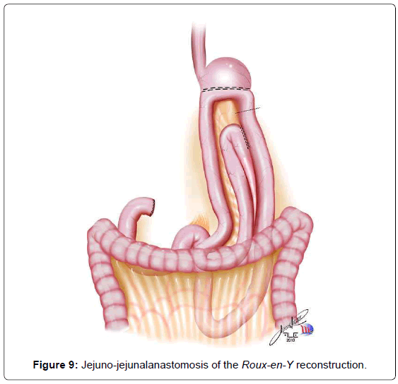 gastrointestinal-digestive-system-Jejuno-jejunalanastomosis