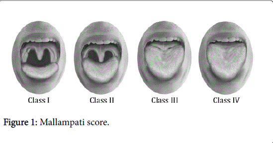 gastrointestinal-digestive-system-Mallampati-score