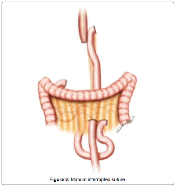 gastrointestinal-digestive-system-Manual-interrupted