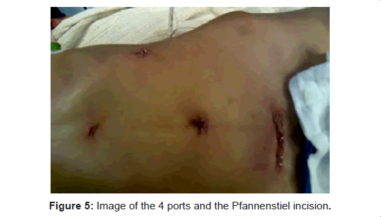 gastrointestinal-digestive-system-Pfannenstiel-incision