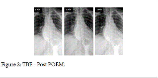 gastrointestinal-digestive-system-Post-POEM