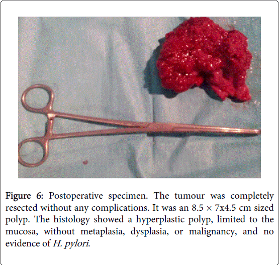 gastrointestinal-digestive-system-Postoperative-specimen