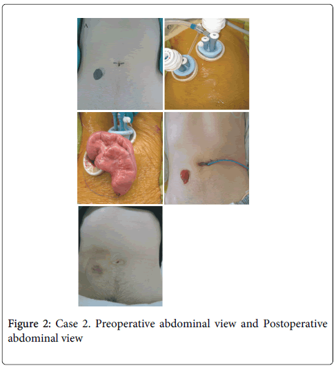 gastrointestinal-digestive-system-Preoperative-abdominal